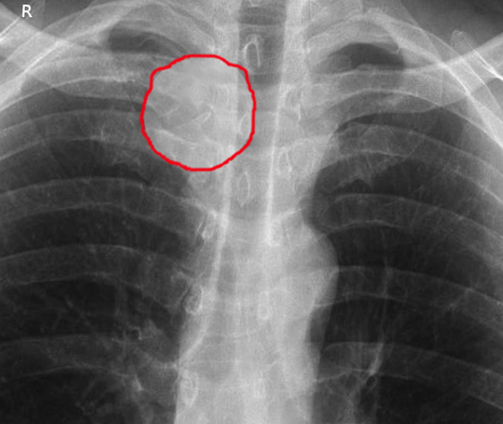 Sternoclavicular infection