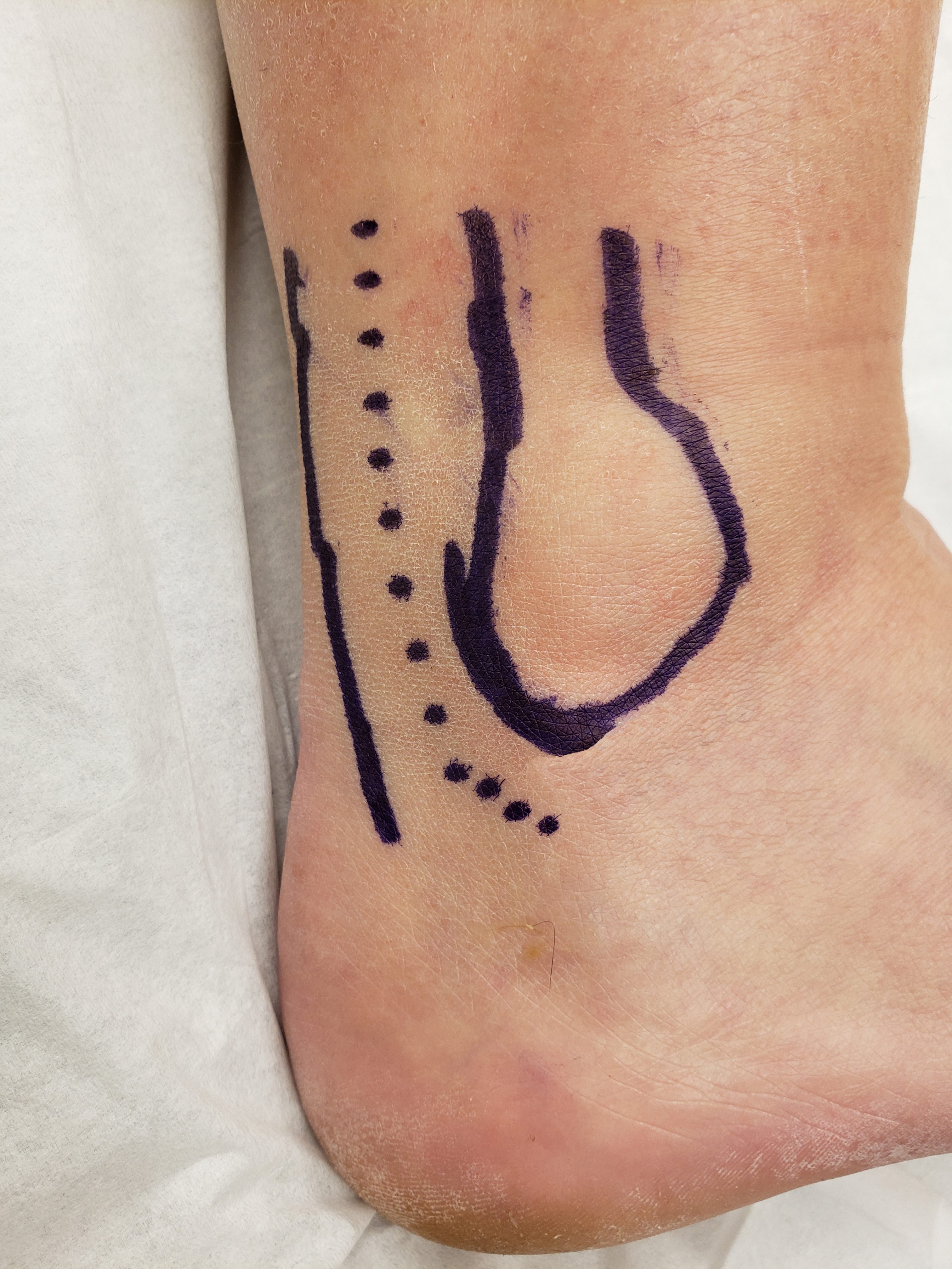 Typical incision on the right lateral ankle for a sural nerve biopsy.  Incision denoted by dotted line.