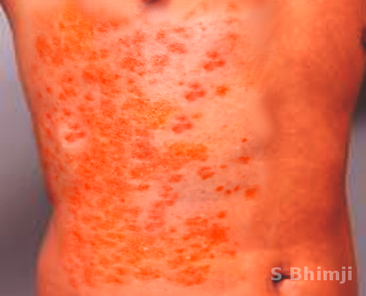 Purpuric rash in WFS