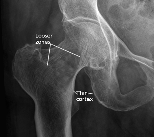 Osteomalacia hip joint