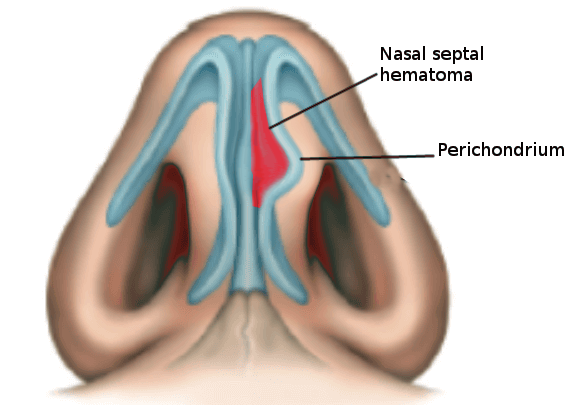 Nasal septal hematoma