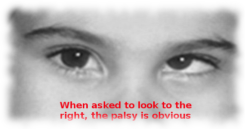 Trochlear nerve palsy