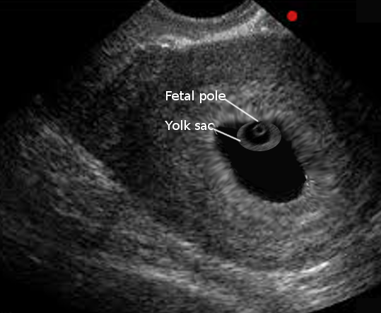 Hip episode fountain Gestational Sac Evaluation Article