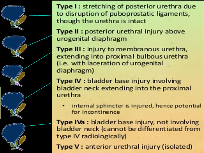 Types of urethral injuries