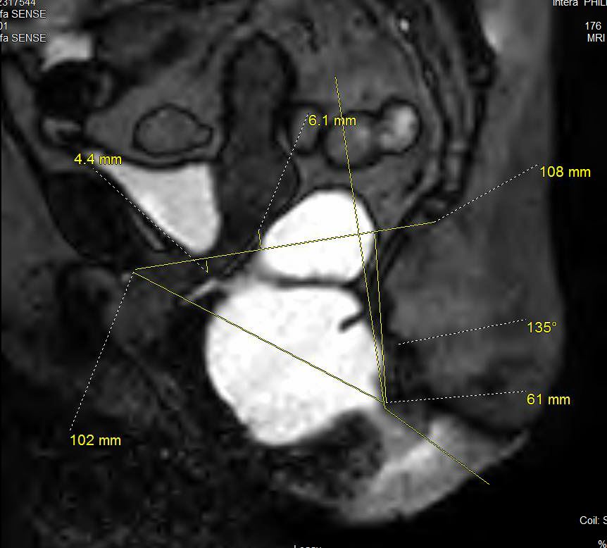 This sagittal image from MR Defecography shows severe perineal descent syndrome involving the posterior compartment. Also note the moderate to severe anterior rectocele. No intrarectal intuscusseption or internal prolapse was seen. This image also demonstrates how all the measurements are performed.