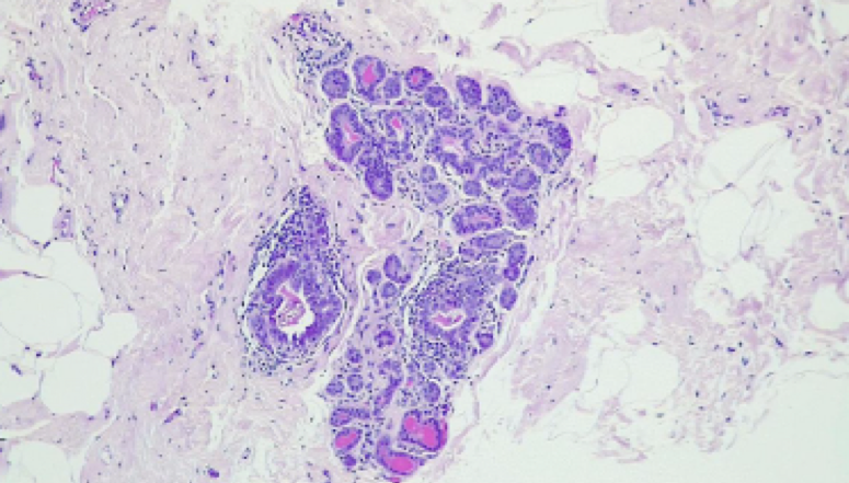 Histologic examination of the specimen submitted confirms female breast tissue with adenosis, epithelial hyperplasia, duct dilatation, chronic inflammation and dystrophic calcifications.  There is no evidence of in-situ or invasive malignancy on the material examined.

Fibroadenosis with dystrophic calcifications

