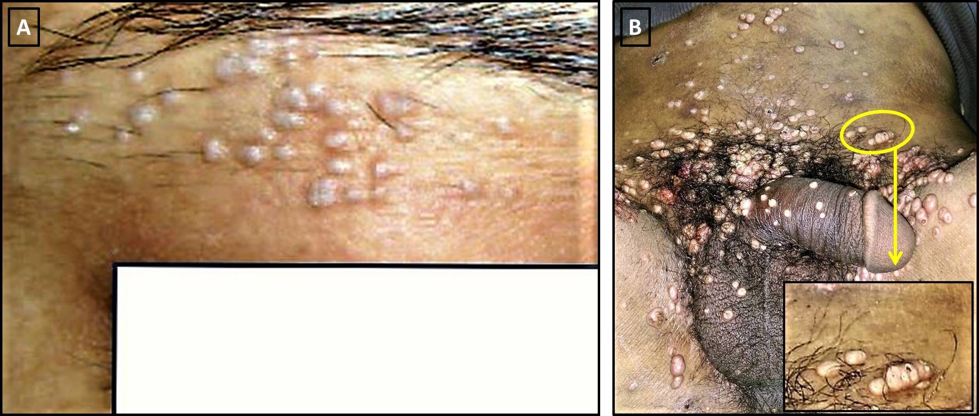 Figure 2 Pseudokoebnerization: (A) Of flat warts in the threading area of a young lady; and (B) Ofmolluscum contagiosum (MC) lesions in an immunosuppressed patient. Appreciate the florid lesions of genital MC and evidence of linear clusters at multiple places. One area (yellow circle) has been magnified in the inset for better appreciation. visible as clustered papules (black circle). In these cases, micro-inoculation or seeding of the viral particles is responsible for this kind of Koebner phenomenon.