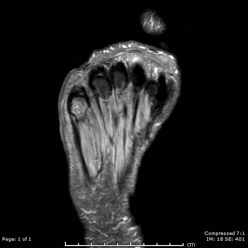 T2-weighted MRI image of a patient's right foot. Patient had history of uncontrolled diabetes, peripheral neuropathy and a long-standing ulceration under the 5th metatarsal head resulting in osteomyelitis of the 5th metatarsal head and shaft. Patient subsequently underwent a partial 5th ray resection with long term IV antibiotics for treatment and healed uneventfully.