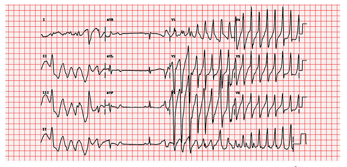 This is a classic 12 lead EKG of a patient with Torsade de Pointes. It shows the polymorphic nature of the tachycardia, the long QT interval and the initiation of the tachycardia with a late coupled P.V.C.