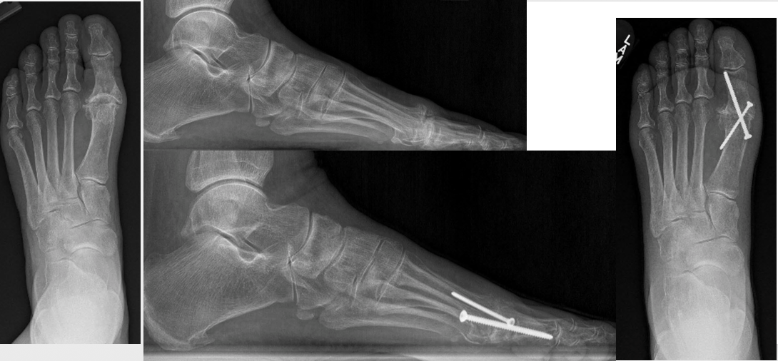 <p>Hallux Rigidus Screws.&nbsp;AP &amp; lateral x-rays of the foot demonstrating pre and post-screw arthrodesis.</p>