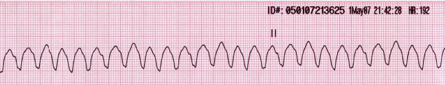 <p>Monomorphic Ventricular Tachycardia on Electrocardiography