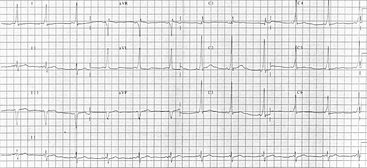 EKG showing WPW syndrome 