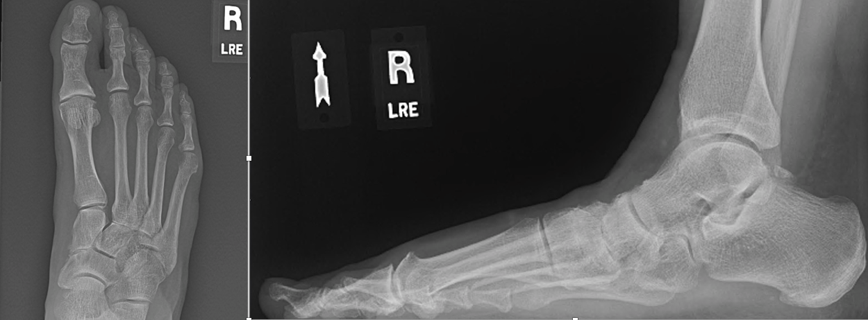 <p>Mild Hallux Rigidus.&nbsp;X-rays of the foot demonstrating mild hallux rigidus.</p>