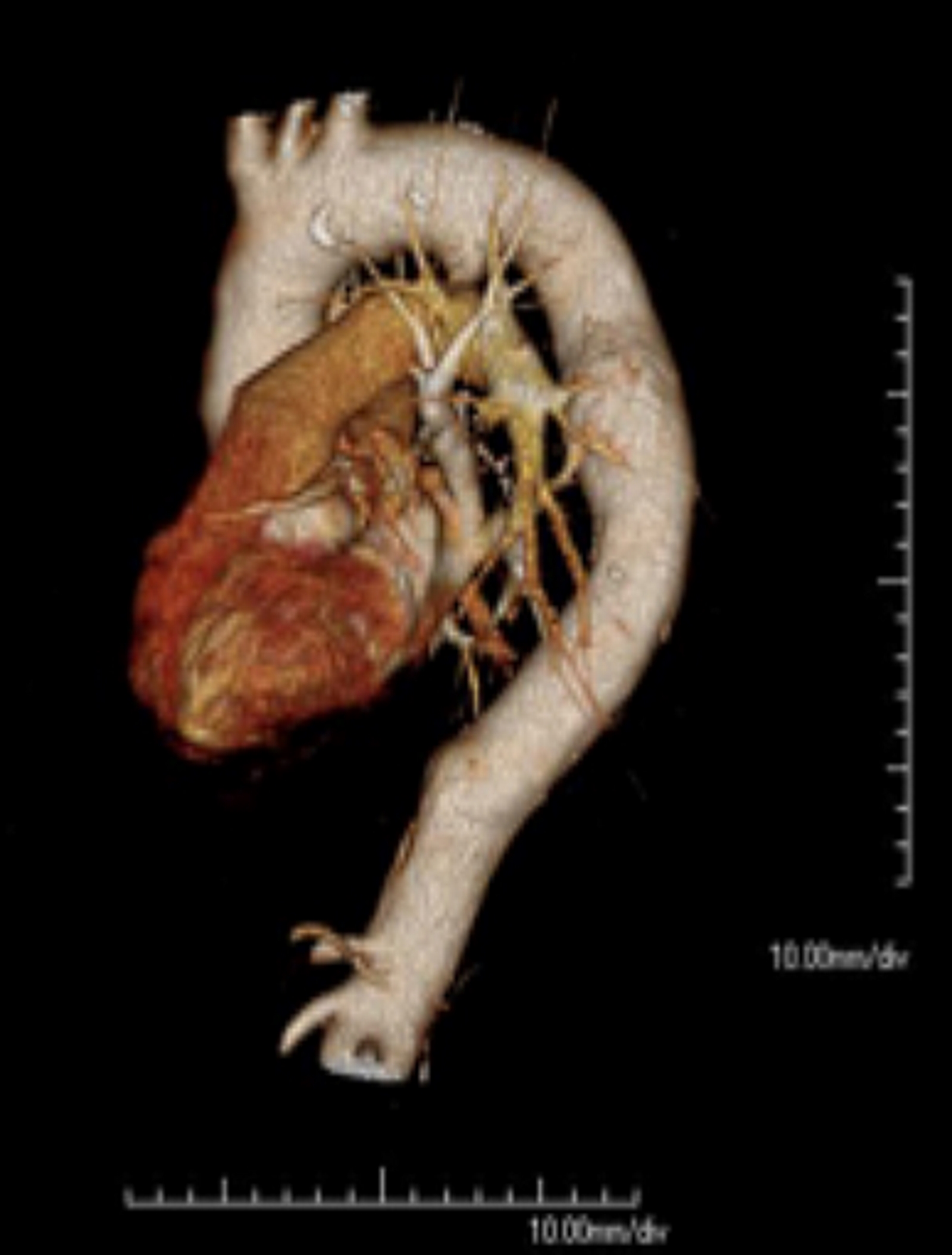 The image shows the thoracic aorta and the aortic arch, through an angio-CT examination.