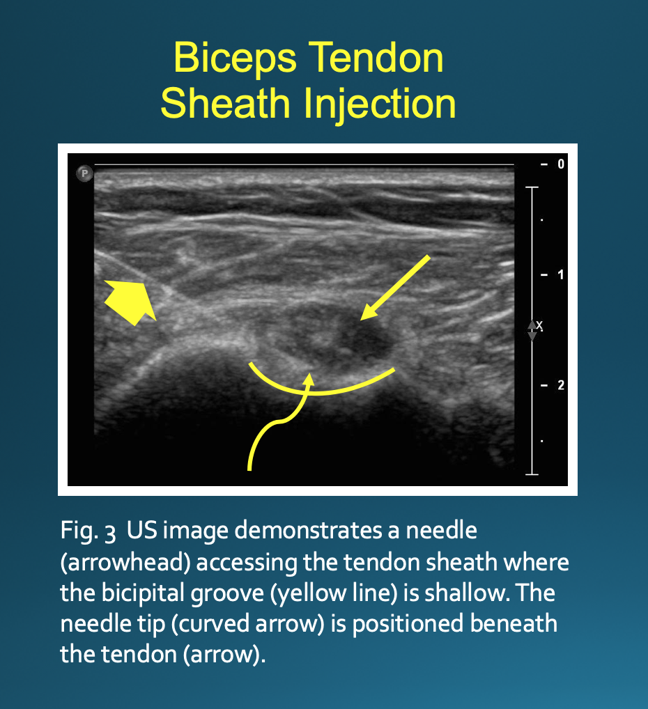 US guided biceps tendon sheath injection