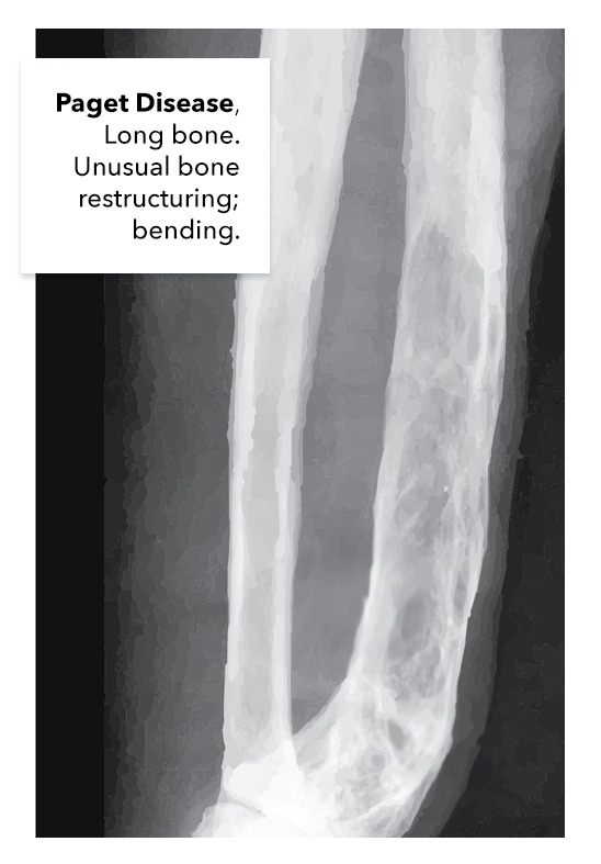 Paget Disease of the long bone