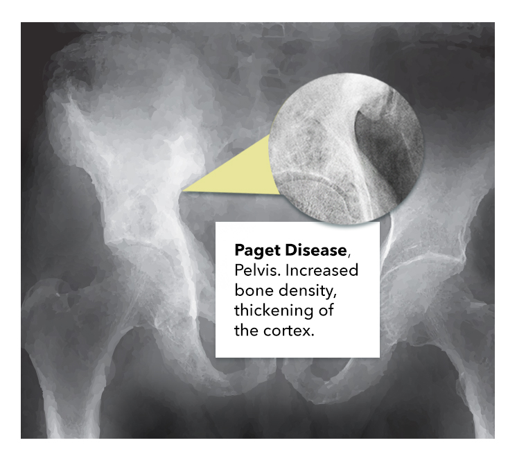 Paget Disease pelvis