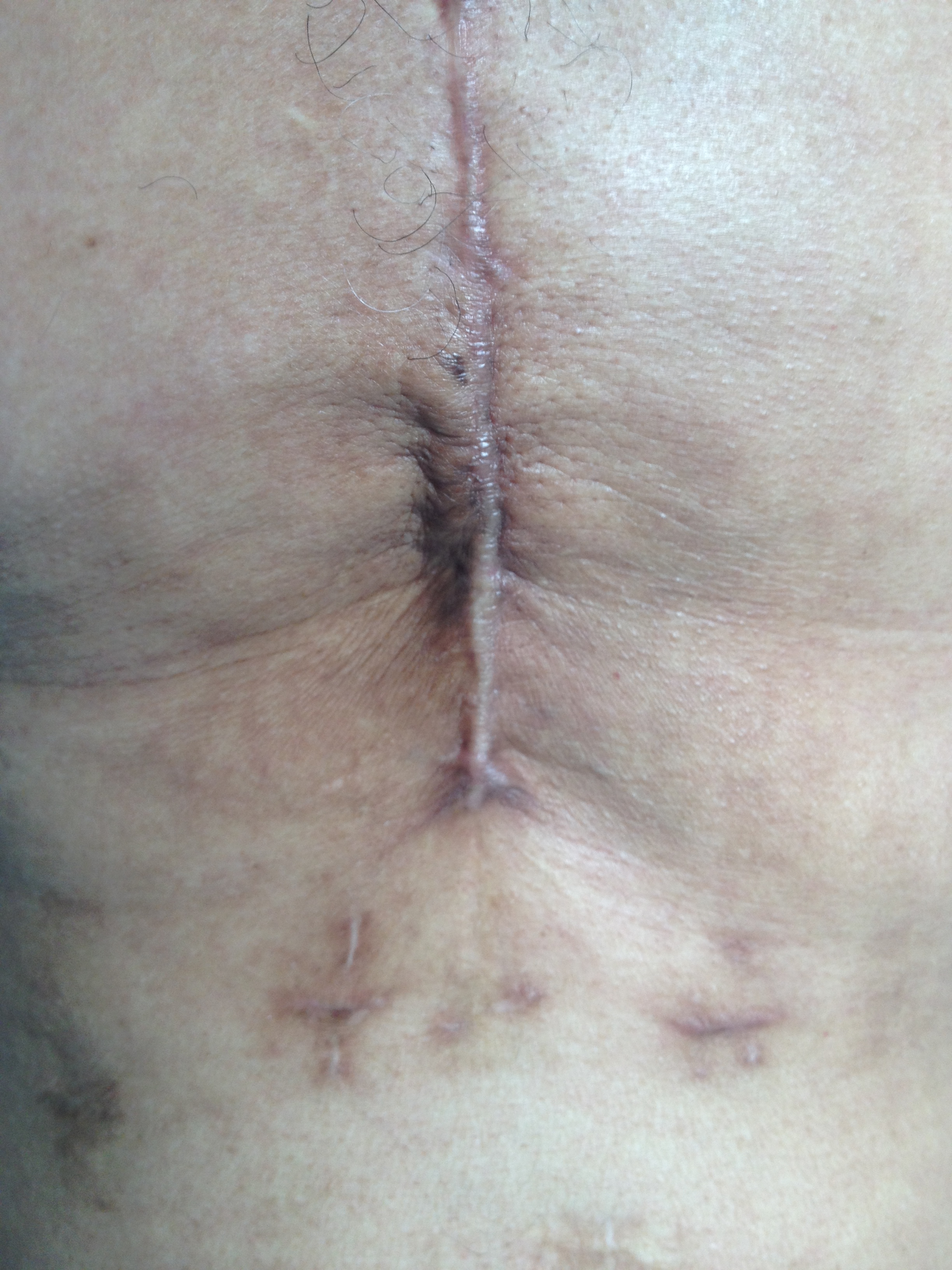 The photo shows a previous sternotomy; the wound has healed and is not infected, but shows a possible evolution in a hypertrophic scar.