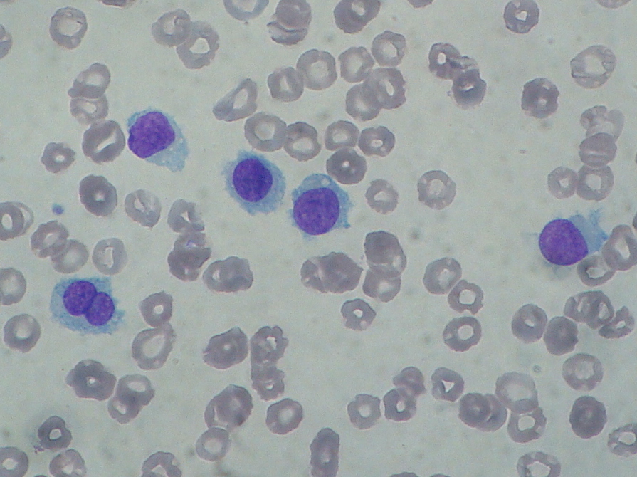Hairy cell leukemia: abnormal B cells look "hairy" under a microscope because of radial projections from their surface.