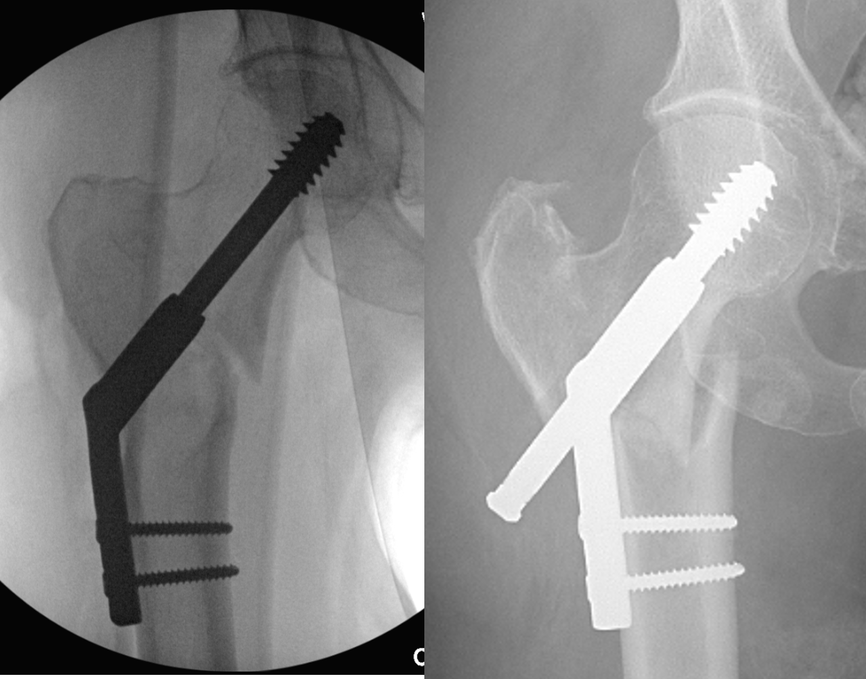 Intra-op and Post-op images of IT femur fracture treated with DHS