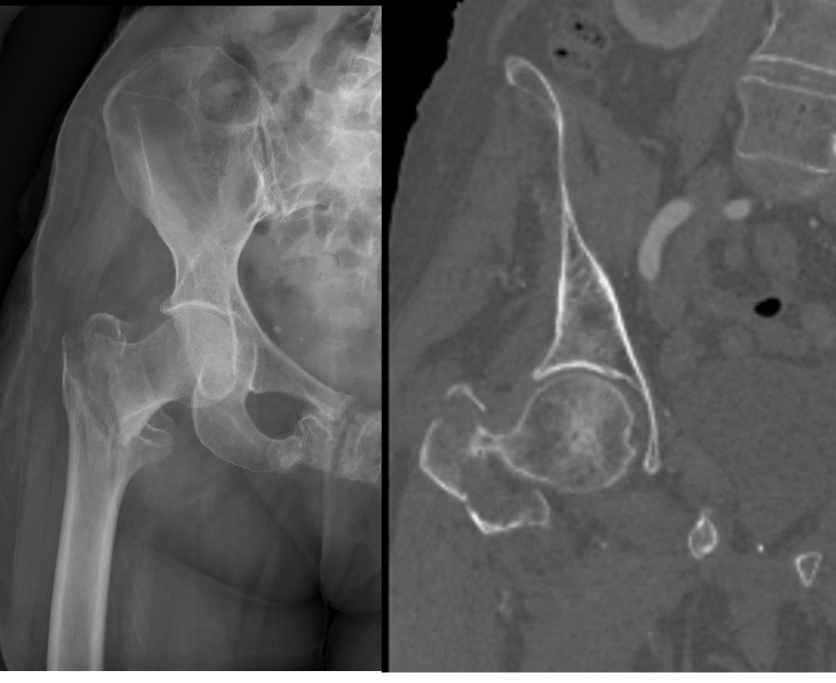 IT femur fracture with incompetent lateral wall