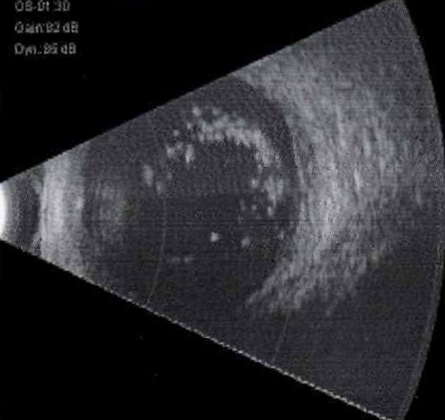 Ultrasound B-Scan image of an eye with asteroid hyalosis. Please note the dot echoes in the vitreous cavity and a clear zone between the dot echoes and the retina.