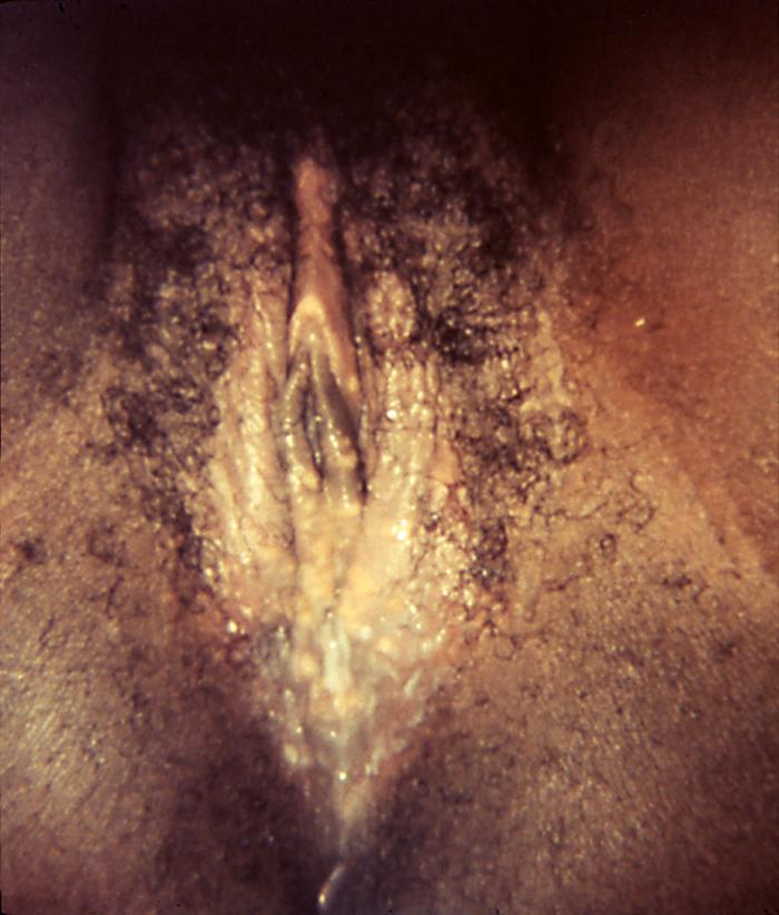 This photograph depicted a close view of a patient’s vagina, revealing evidence of an outbreak of herpes genitalis, which had manifested as pustular-vesicular rash around the vaginal introitus, due to the herpes simplex virus type-2 (HSV-2) virus