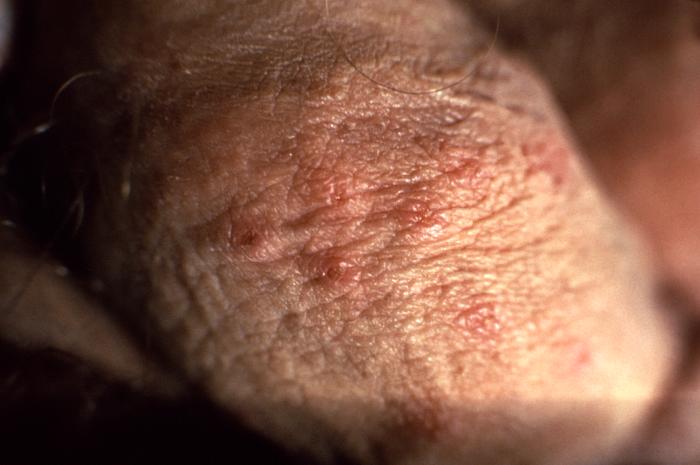 This image depicts a close view of a patient’s penile shaft, highlighting the presence of a crop of erythematous vesiculopapular lesions, which were determined to have been caused by a herpes genitalis outbreak