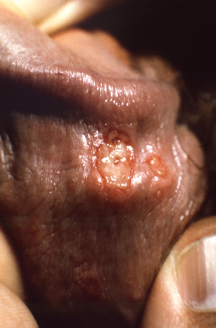 This was an outbreak of herpes genitalis, which had manifested as blistering on the underside of the penile shaft, just proximal to the corona of the glans, which was due to the herpes simplex 2 (HSV-2) virus, otherwise referred to as genital herpes