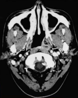 A CT image of a patient with a Left sided nasopharyngeal mass involving the posterior pharyngeal wall and showing minor opacification of the maxillary antrum bilateral