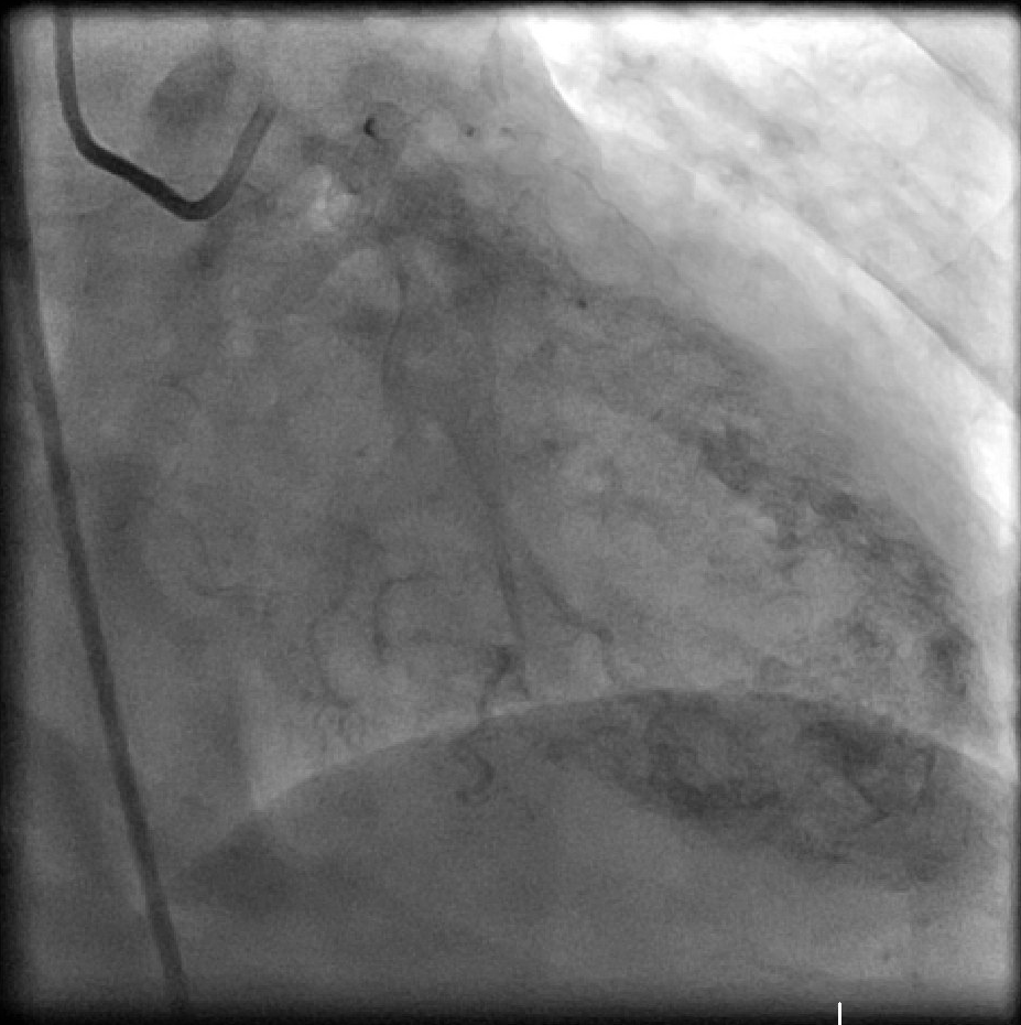 Image 1. Selective left coronary angiogram showing filling of left ventricle with left coronary artery injection indicating coronary-cameral fistula