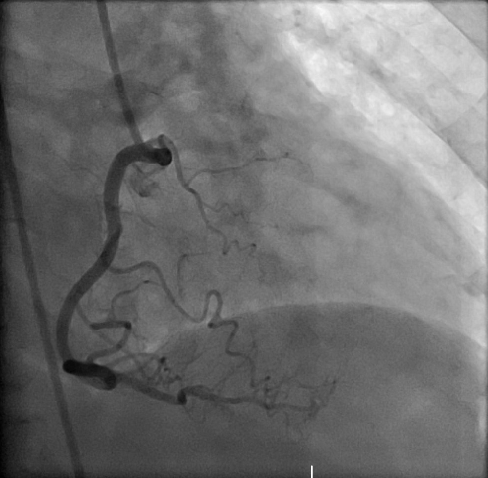 Image 2: Selective coronary angiogram showing filling of the ventricle with right coronary artery injection suggestive of coronary-cameral fistula.