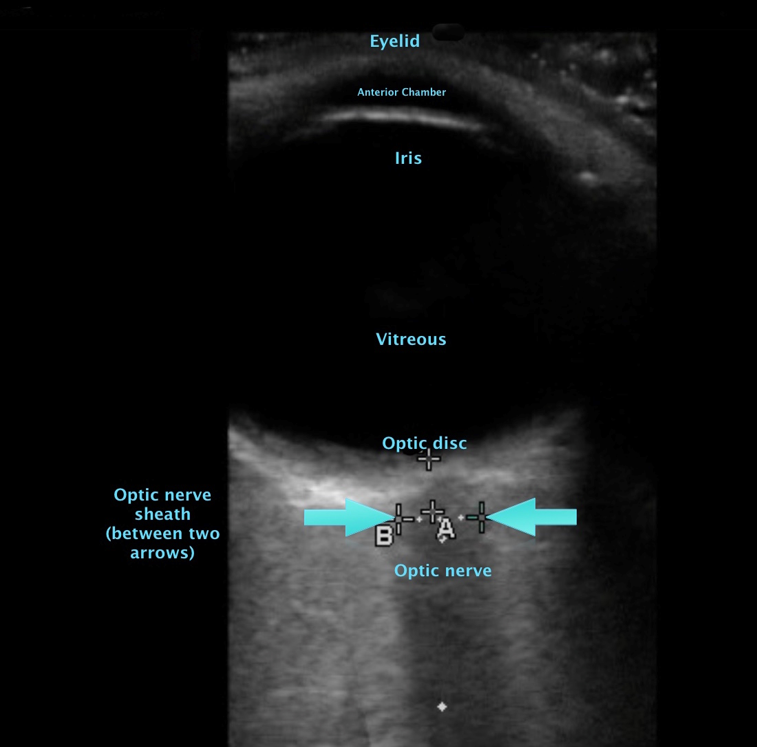 optic nerve sheath measurement