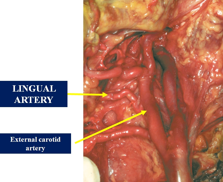 The figure shows the lingual artery from the external carotid artery.