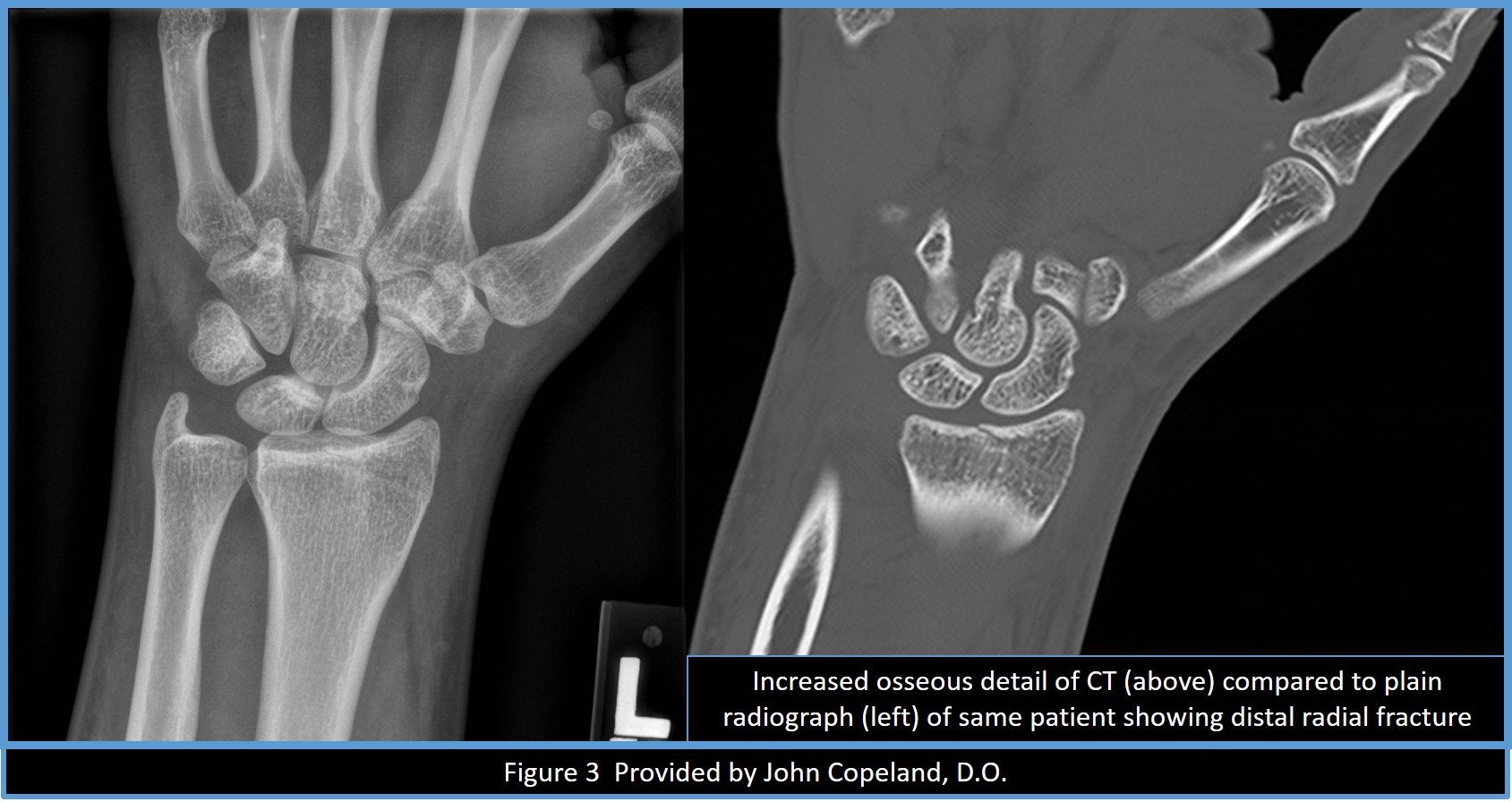CT versus plain film x-ray wrist fracture