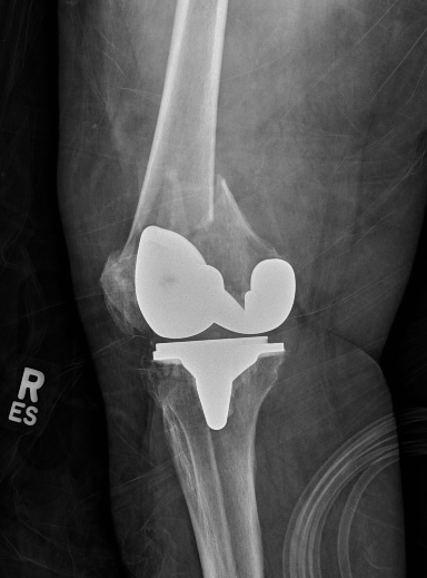 Anteroposterior view of a periprosthetic distal femur fracture about a cemented cruciate retaining total knee arthroplasty