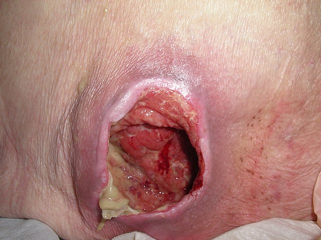 Close up shot of Stage 4 Ulcer 