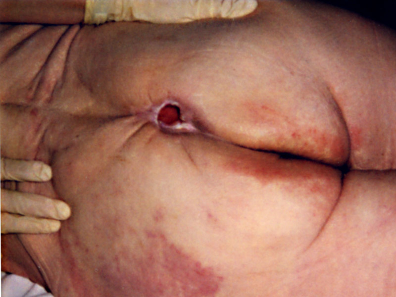 Example of a pressure ulcer