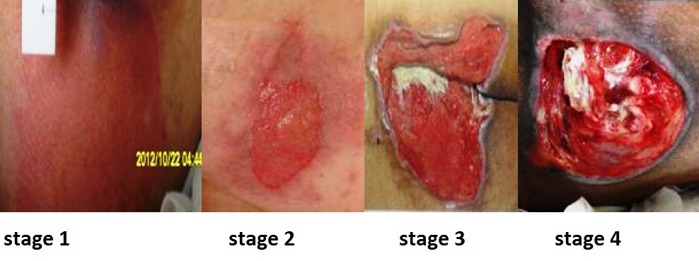 Stages of Ulcers 