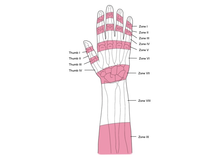 Extensor tendon zones in the hand