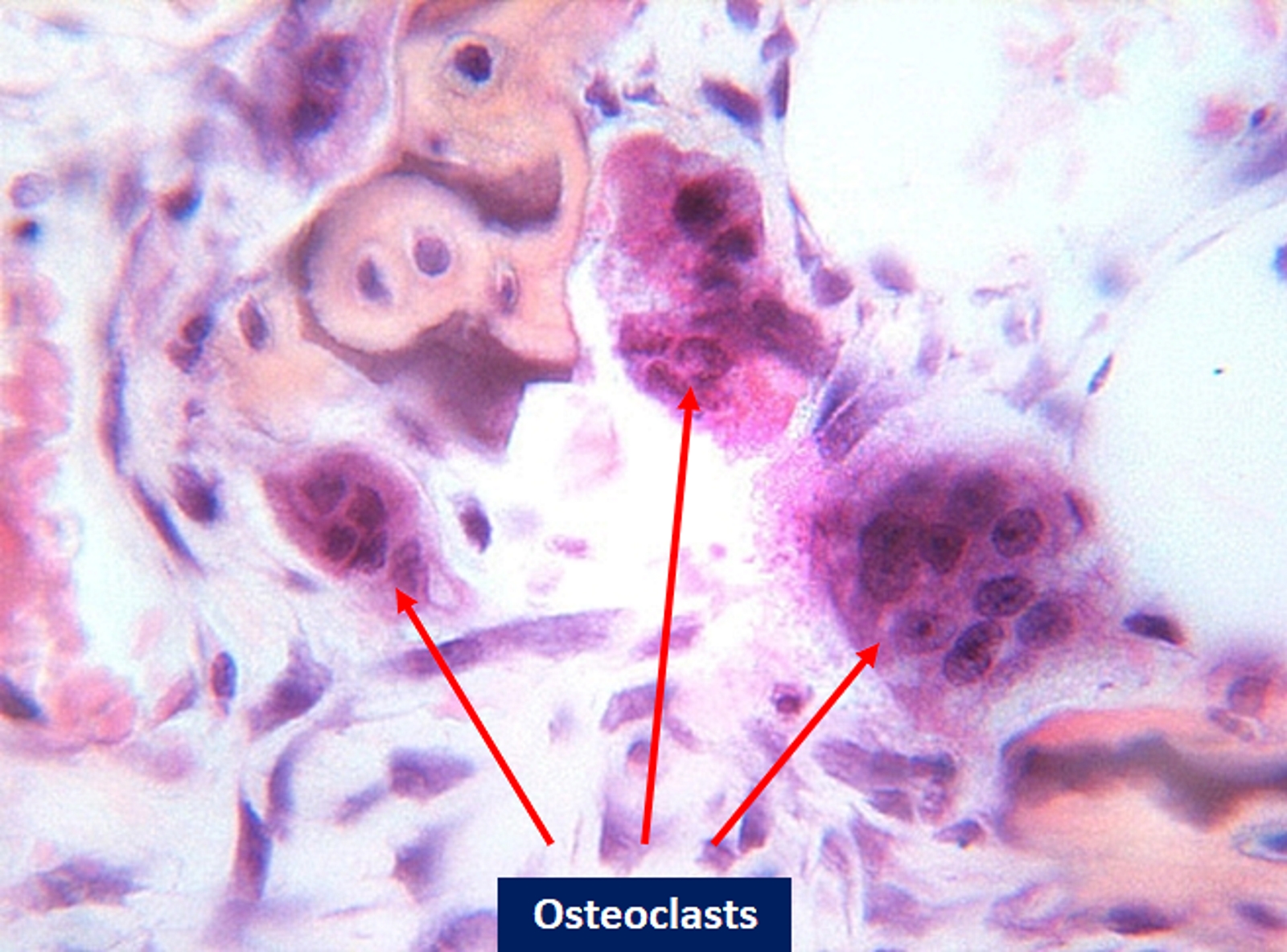 The electron microscope image shows the cells: osteoclasts.