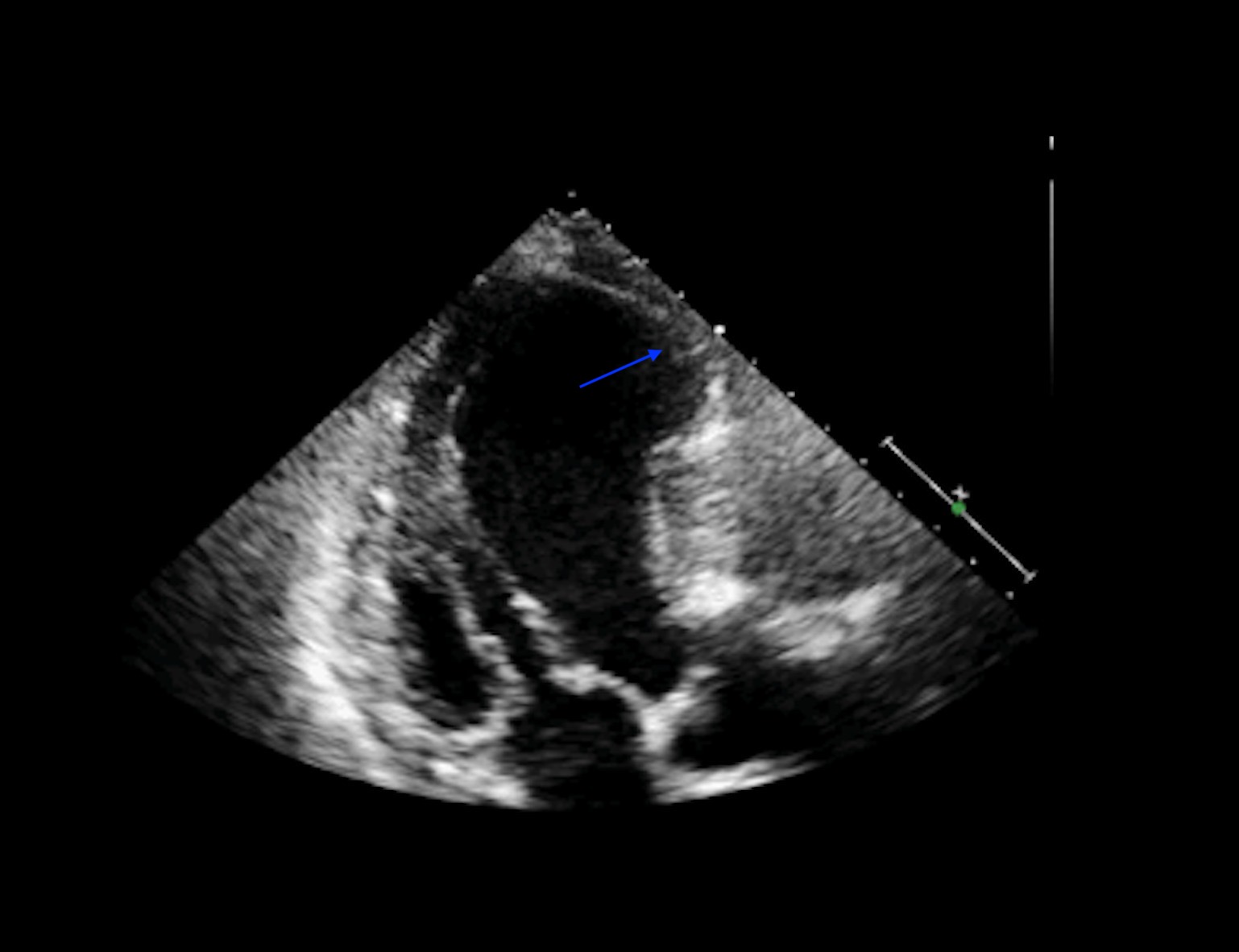 Figure 1: Showing Left ventricle aneurysm on transthoracic echocardiogram. 