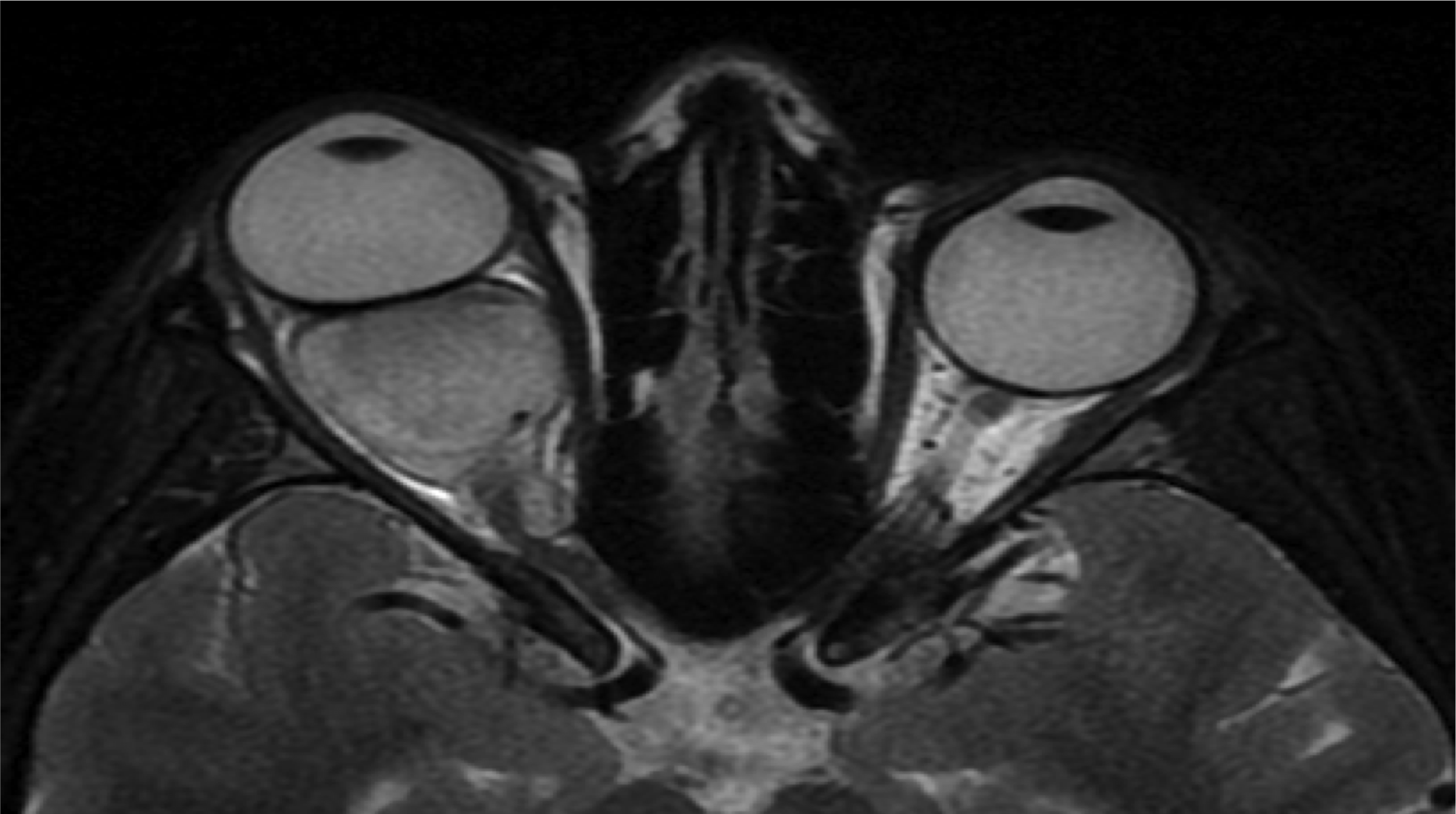Axial MRI of right optic nerve glioma.