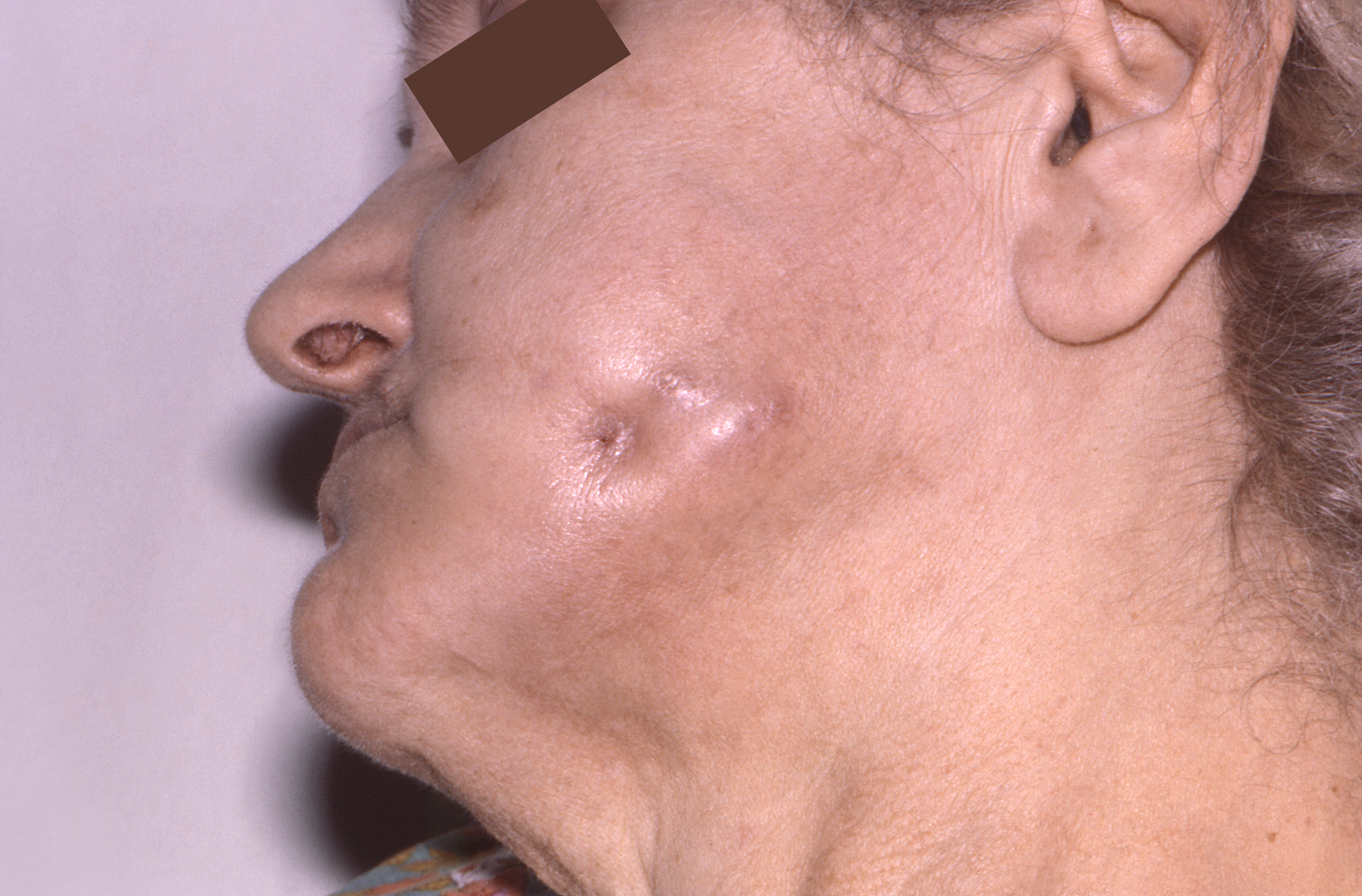 Seen from the left lateral perspective, this female patient displayed a fistula that had formed on the region of her left cheek, which had been brought on by an infection known as actinomycosis, or mycetoma, caused by the Gram-positive, fungus-like aerobic bacteria of the order Actinomycetales. Mycetoma is a slowly progressive, destructive infection of the cutaneous and subcutaneous tissues, fascia, and can progress to a point where it can affect bone as well.