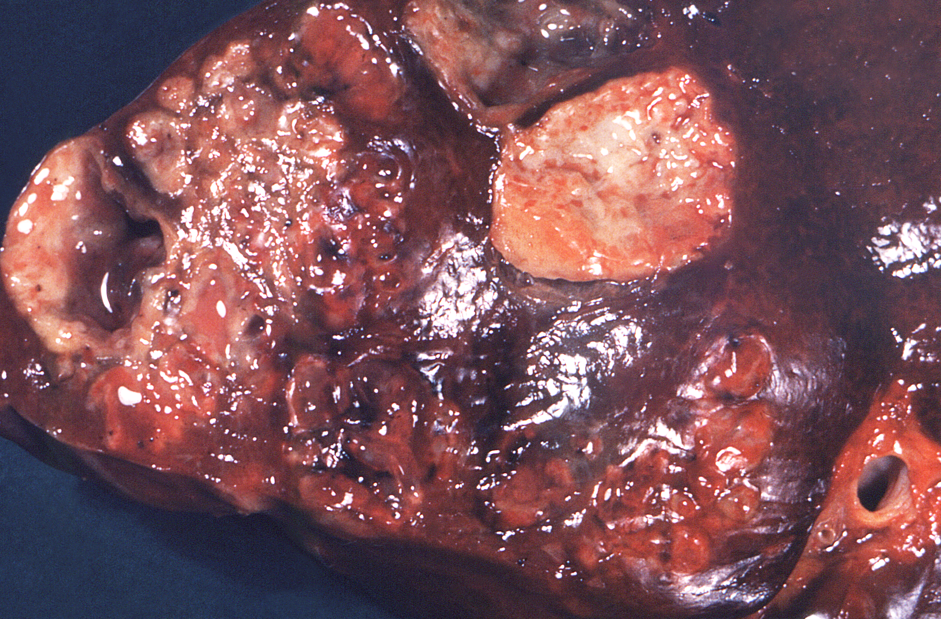 This cut section of human liver, revealed the presence of numerous suppurative, or pus containing lesions due to an infection known as actinomycosis, caused by the Gram-positive, fungus-like, aerobic bacteria of the order Actinomycetales