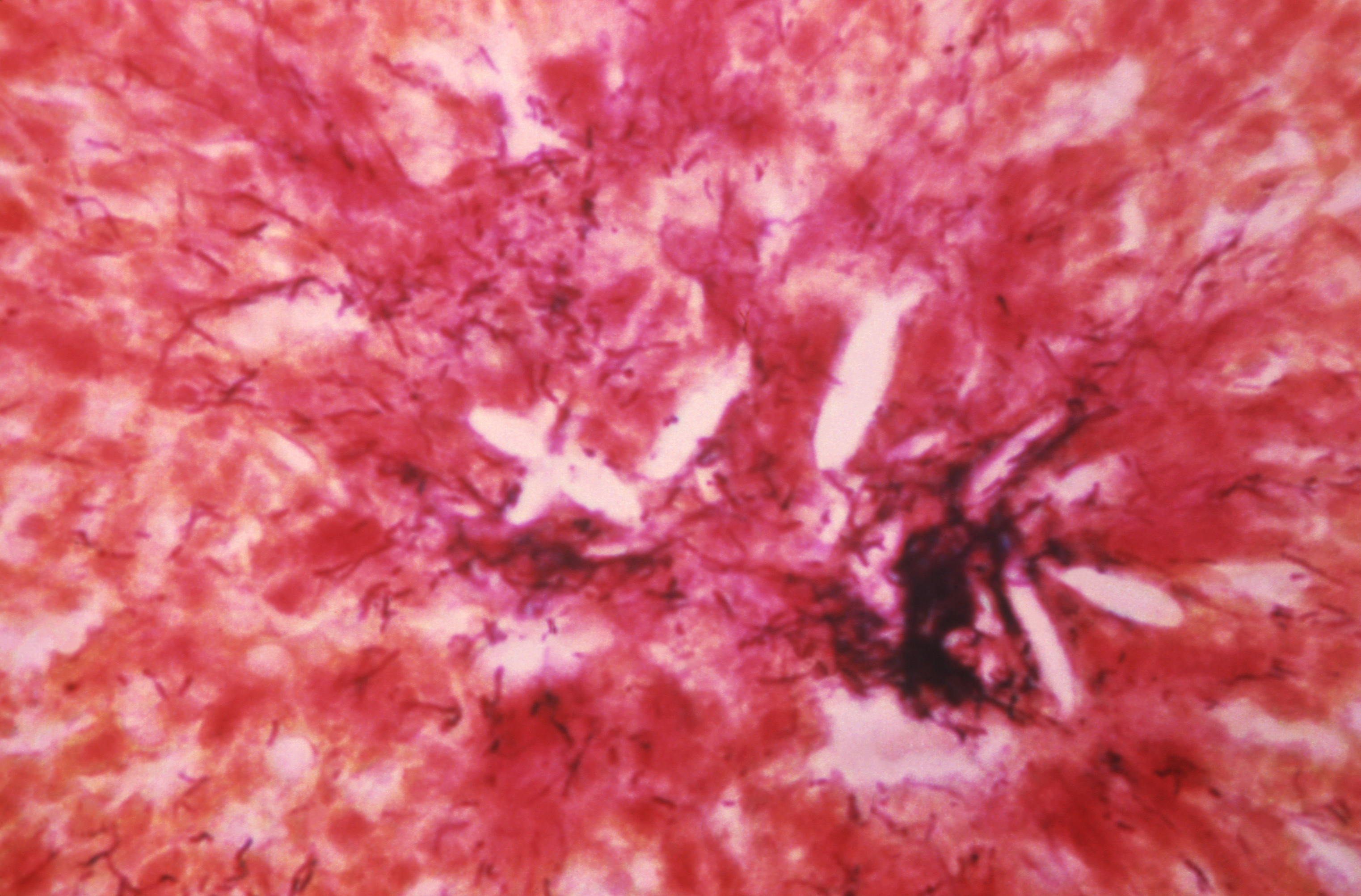 Under a magnification of 200X, this photomicrograph of a Gram-stained brain tissue specimen, revealed the presence of a chronic inflammatory sulfur granule in a case of actinomycosis, caused by a Gram-positive, fungus-like aerobic bacterium of the genus, Actinomyces.