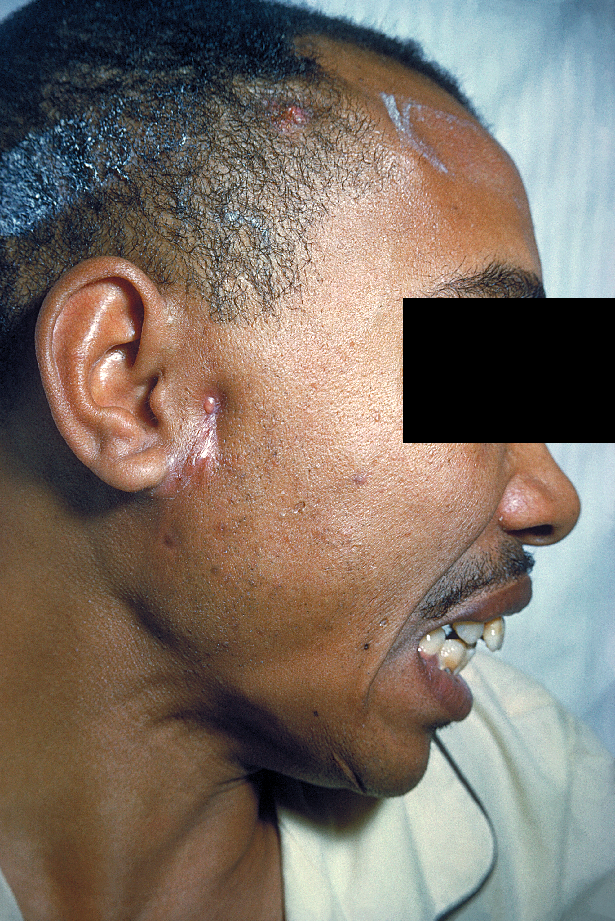This image depicts a right lateral view of a patient’s head and neck, revealing a cutaneous lesion, just anterior to the right ear, which was determined to be a case of actinomycosis. Actinomyces spp., normally found in the oral cavity, can become an opportunistic pathogen, a situation usually seen only in immunosuppressed patients. Lesions involve long-standing swelling, suppuration and the formation of an abscess or granuloma.