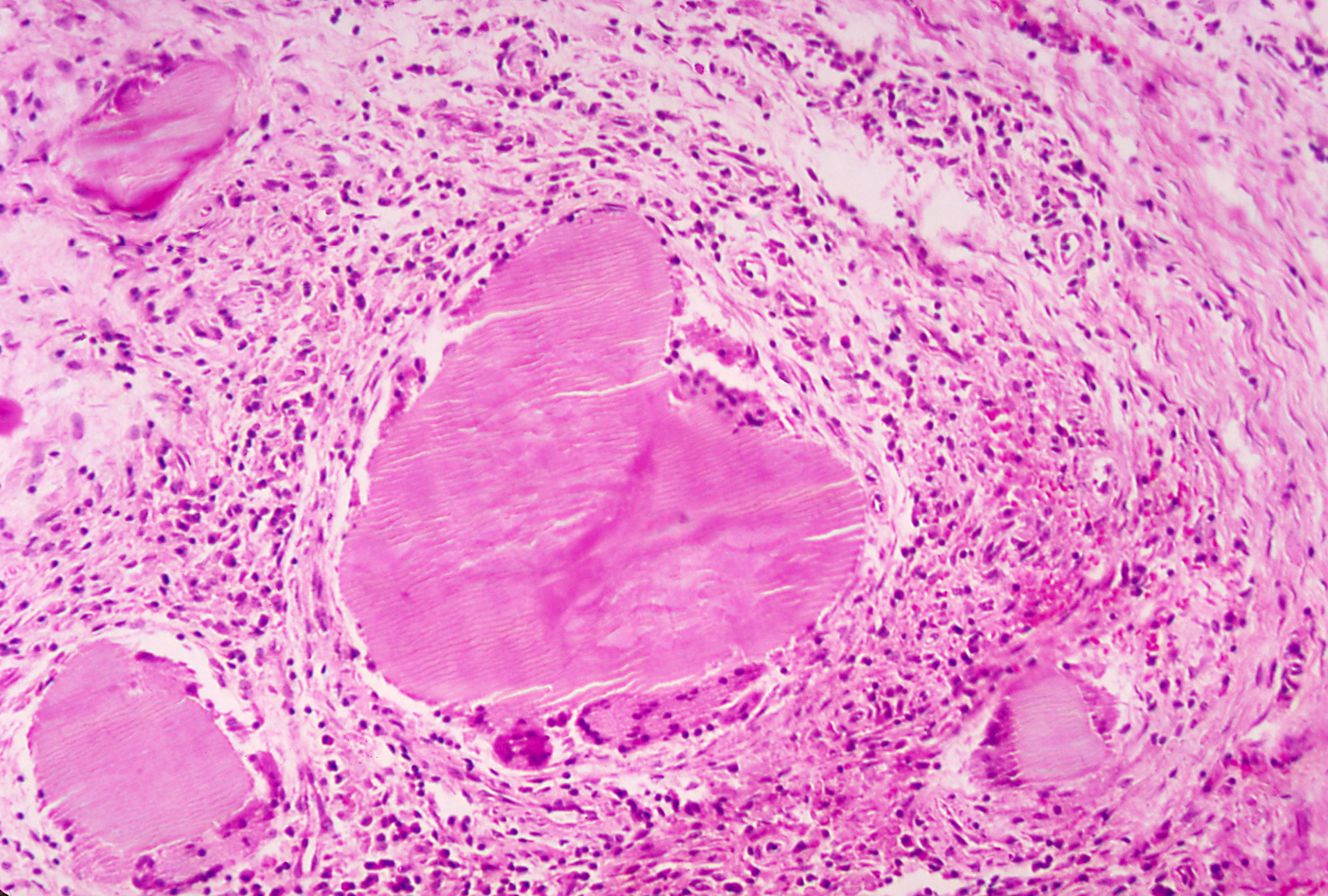 This photomicrograph of an unidentified tissue specimen was harvested from a patient, who had presented with a case of actinomycosis, caused by the Gram-positive, aerobic actinomycete, Streptomyces somaliensis