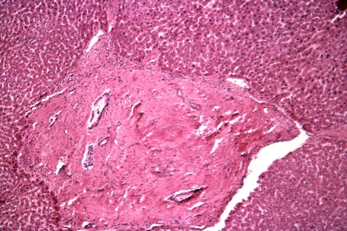 Under a magnification of 500X, this photomicrograph of a liver tissue specimen revealed sign of a schistosomiasis infection, included a histopathologic finding known as pipe stem cirrhosis, which occurs when schistosomes infect the liver, known as hepatic schistosomiasis