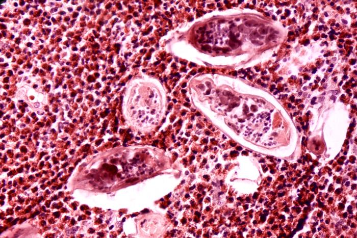 This photomicrograph depicts some of the histopathologic details seen in a bladder tissue specimen, in a case of schistosomiasis haematobium, also known as urinary blood fluke, caused by the parasitic flatworm, Schistosoma haematobium. Note the presence of clusters of S. haematobium ova, surrounded by intense eosinophilic infiltrates, and other inflammatory cells. For another view of this condition, at a lesser magnification, see PHIL 34.